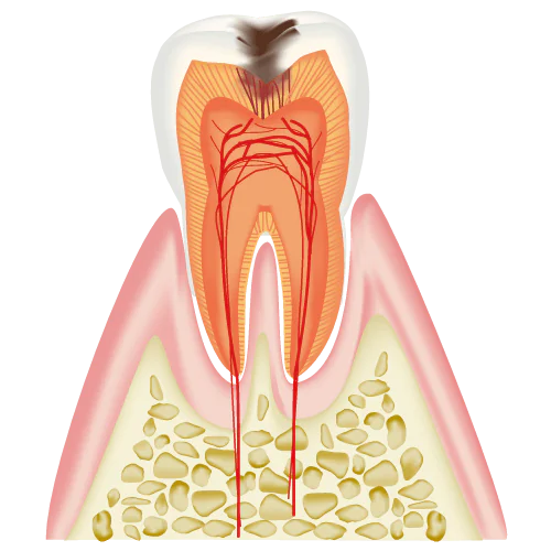 象牙質まで進んだむし歯(C2)